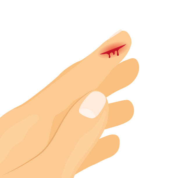 Slashed Bleeding 890+ Blood Wound Fingernail Stock Photos, Pictures & Royalty-Free ...