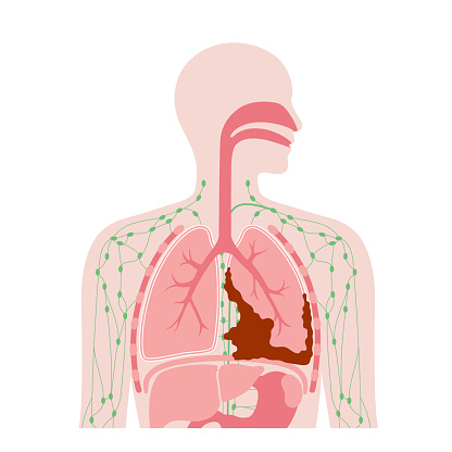 Mesothelioma tumor cells poster. Lung cancer concept. Respiratory system illness. Asbestos related diseases. Shortness of breath, pain in chest, breathing problem, medical  flat vector illustration.