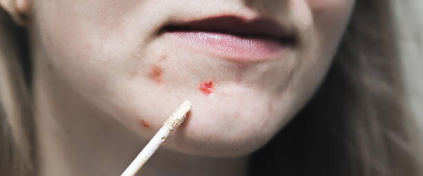 istock Woman is covering acne with concealer. Makeup for oily skin with problems. 1493129453