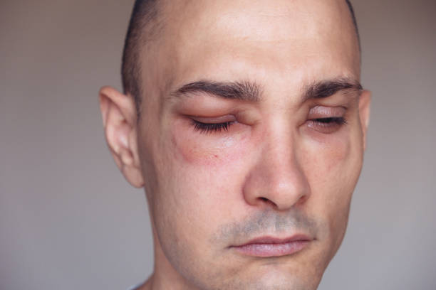 白人男性は、虫刺され、食物、薬などの薬剤に対するアレルギー反応によって引き起こされる目の周りの血管浮腫を持っています。腫れた顔、接写。 - angioedema ストックフォトと画像