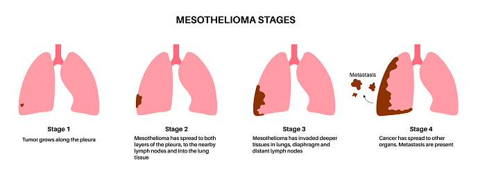 Lung cancer stages, mesothelioma tumor cells spreading. Respiratory system illness. Asbestos related diseases. Shortness of breath, pain in chest, breathing problem, medical  flat vector illustration.