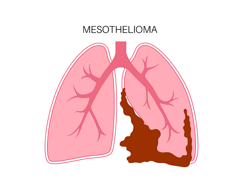 Mesothelioma tumor cells poster. Lung cancer concept. Respiratory system illness. Asbestos related diseases. Shortness of breath, pain in chest, breathing problem, medical  flat vector illustration.