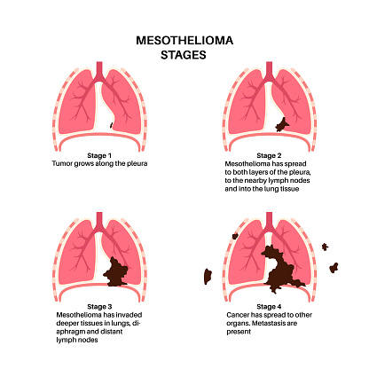 Lung cancer stages, mesothelioma tumor cells spreading. Respiratory system illness. Asbestos related diseases. Shortness of breath, pain in chest, breathing problem, medical  flat vector illustration.