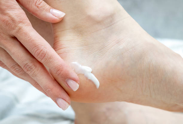 istock woman callus on feet 1493431043