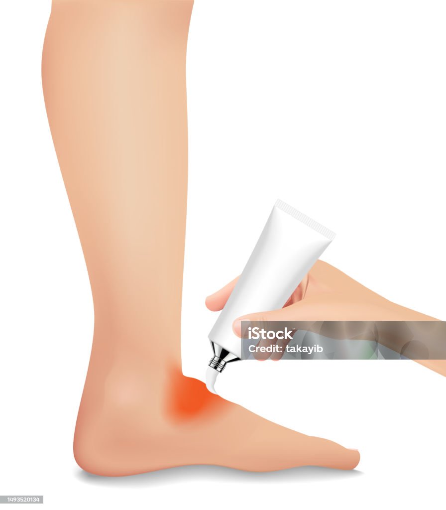 The Injured Foot Stock Illustration - Download Image Now - Adult, Ankle ...