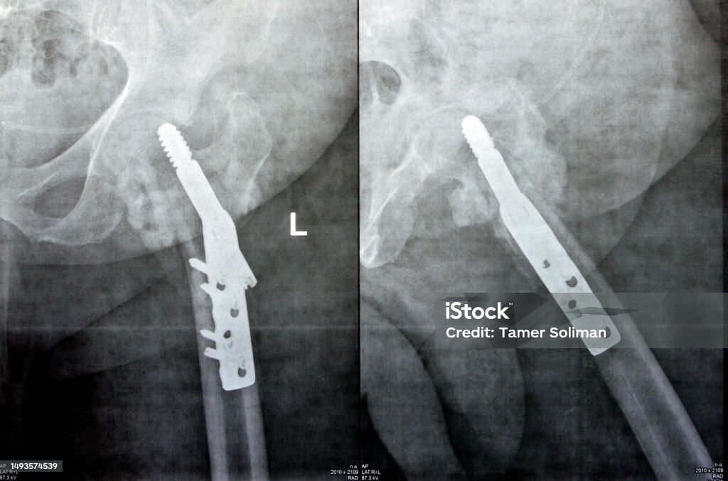 Dhs Radiopaedia Photo libre de droit de Fracture Cervicale Transcervicale De La Hanche ...