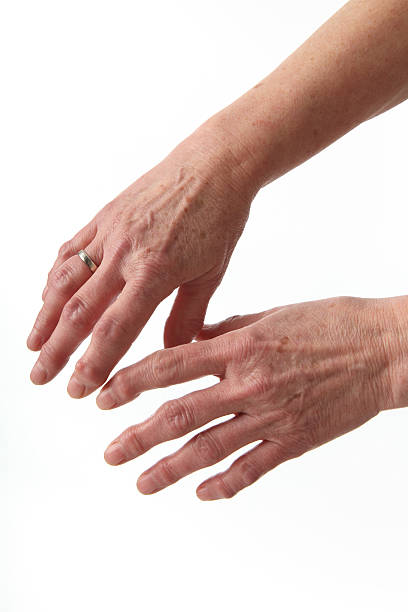 istock Close up of two arthritic hands on white background 149357674