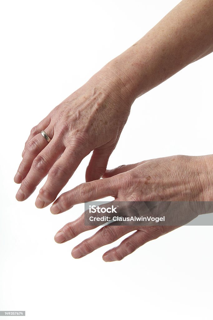 Mãos com Artroses - Royalty-free Artrite Reumatoide Foto de stock