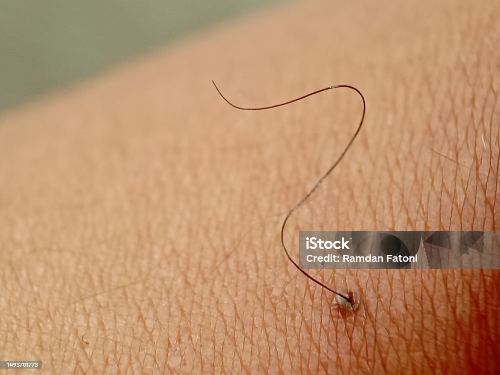 두더지 모반 모반 매크로 사진은 머리카락이 있는 인간의 피부에 있습니다 클로즈업 의사에 대한 스톡 사진 및 기타 이미지 - 의사 ...