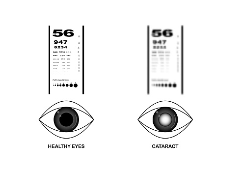 Comparison of healthy eyes and cataract eyes vision on eye examination snellen chart. Vector illustration.