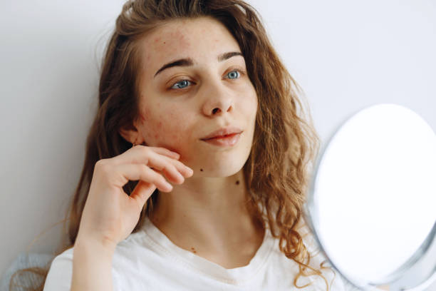 istock Beautiful woman with problem skin looking into mirror. Dermatology. 1493938618