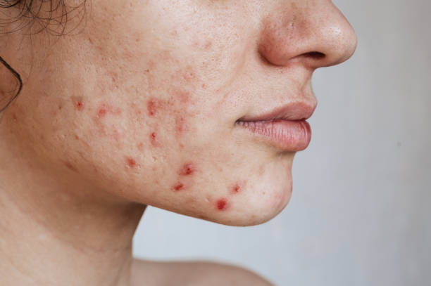 Close-up of the skin of a young girl with problems. Pimples, acne, pores, scars. Natural skin without filters Close-up of the skin of a young girl with problems. Pimples, acne, pores, scars. Natural skin without filters. acne stock pictures, royalty-free photos & images