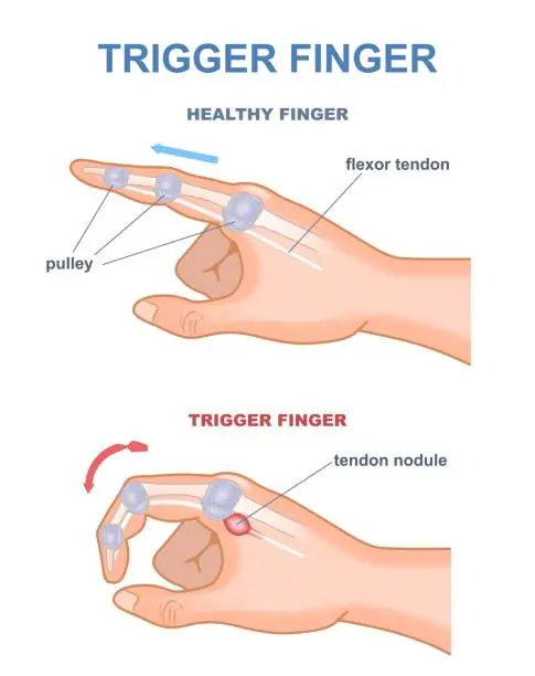 Vector illustration of Trigger finger diagram