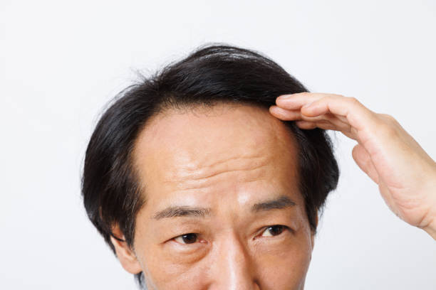 istock Mature Japanese man with hair loss problem 1494151012
