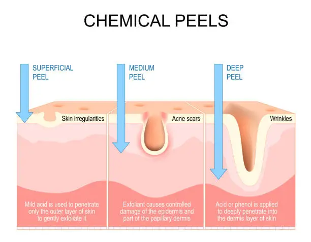 Vector illustration of Chemical peels. Exfoliation