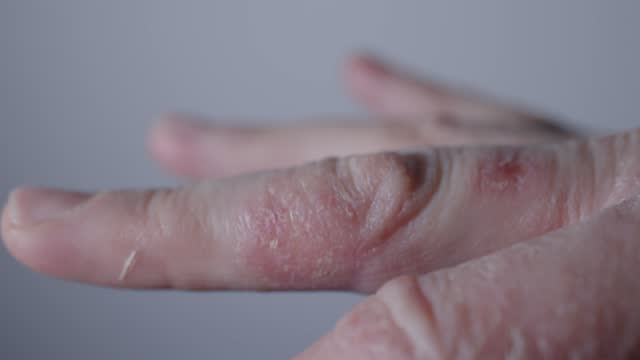 dermatology dry skin eczema disease psoriasis itchy epidermis palm hand disease
