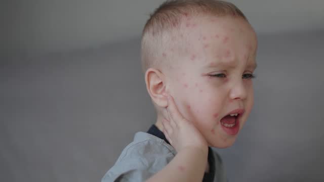 baby child little kid chicken pox disease on face red pimples symptoms boy suffer