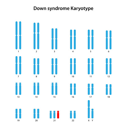 Down syndrome (trisomy 21) is a genetic condition caused by an extra 21 chromosome.