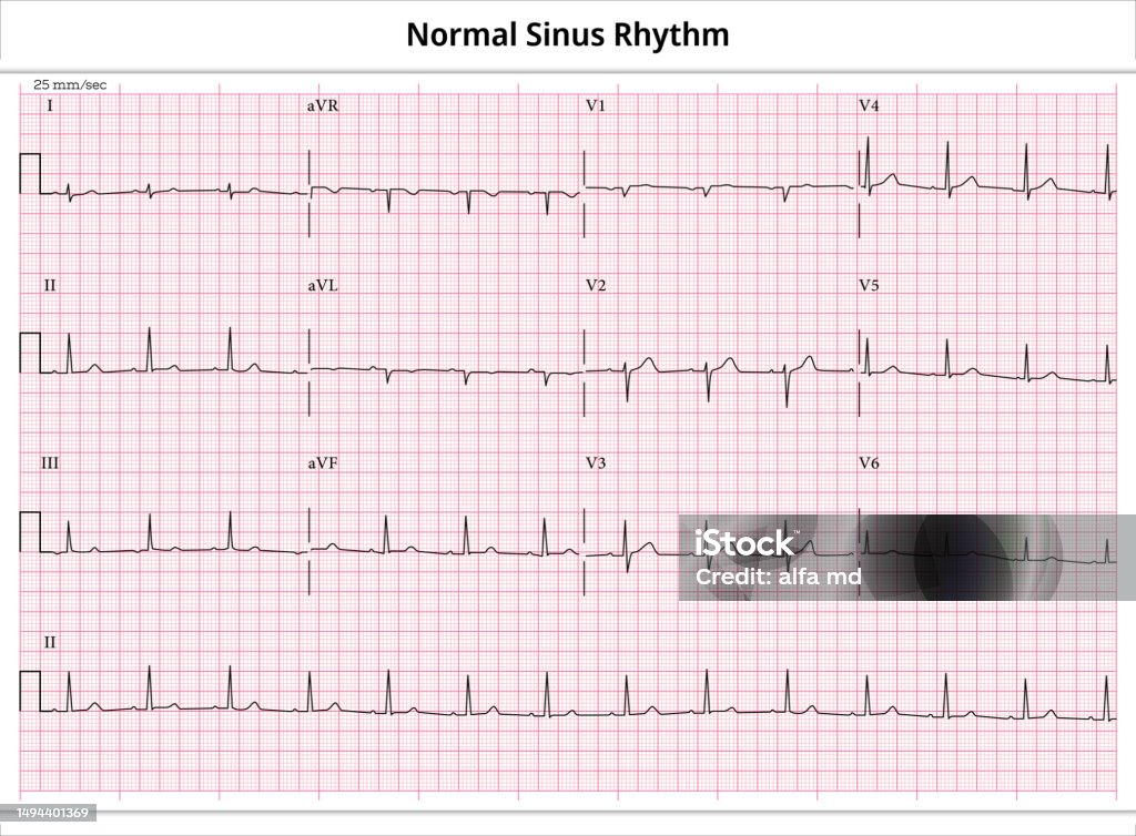 Normal Ecg Examples Ecg Normal Sinus Rhythm 12 Lead Ecg Common Case 3 Sec Lead Stock ...