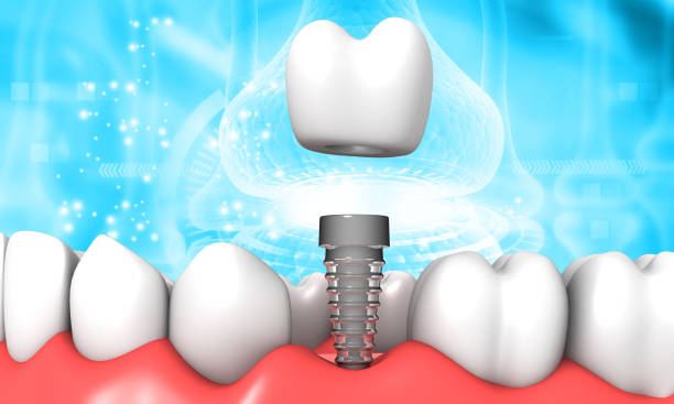 dental implants concept - implantat imagens e fotografias de stock