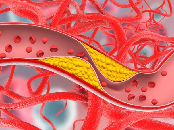 istock Clogged arteries, Cholesterol plaque in artery 1494519081