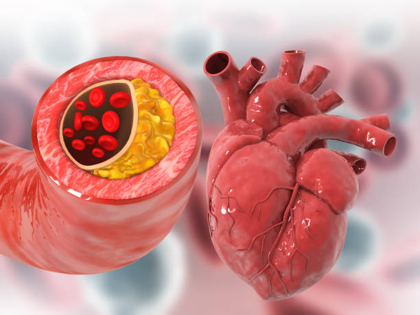 istock Cholesterol plaque in artery with human heart anatomy 1494519103