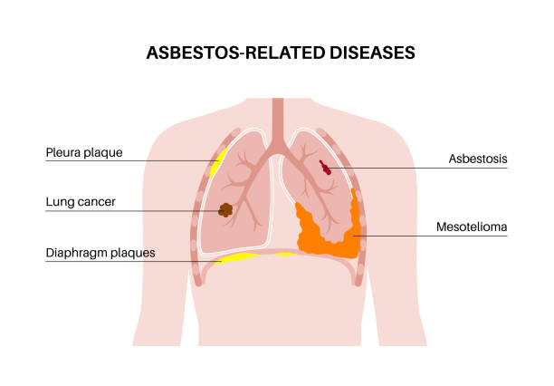 Asbestos related diseases vector art illustration