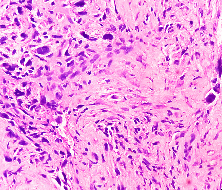 Bone cancer. Chondroblastic osteosarcoma. It's very rare cancer, microscopically show atypical mesenchymal cells, bizarre cells.