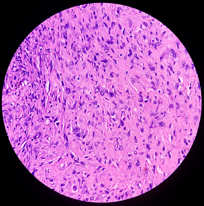 Bone cancer. Chondroblastic osteosarcoma. It's very rare cancer, microscopically show atypical mesenchymal cells, bizarre cells.