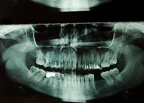 istock Dental X-ray, Orthopantomography or OPG 1495290946