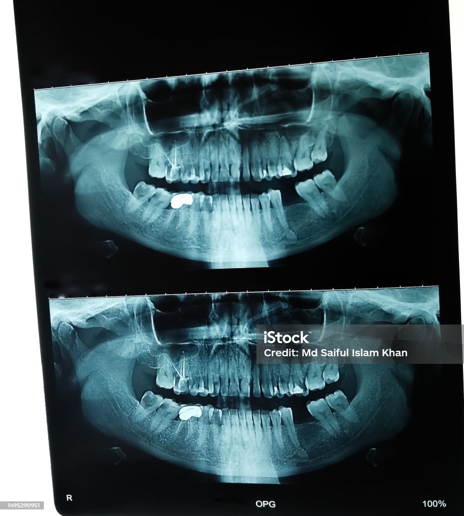 Pan Röntgen Zahnärztliches Röntgen Orthopantomographie Oder Opg Stockfoto und mehr ...