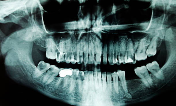 istock Dental X-ray, Orthopantomography or OPG 1495290964