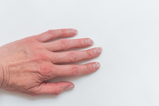 Close-up of a woman's age-old hand with wrinkles with natural nails, overgrown cuticle on a white background. Crooked fingers, gout. A hand with age-related changes. The concept of natural nails