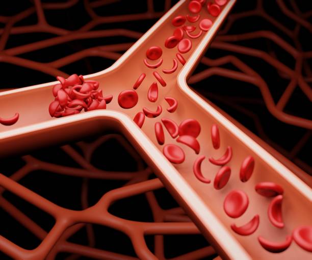 Sickling of red blood cells can increase the risk of developing blood clots Sickling of red blood cells can increase the risk of developing blood clots in the deep veins called deep-vein thrombosis 3d rendering sickle cell stock pictures, royalty-free photos & images