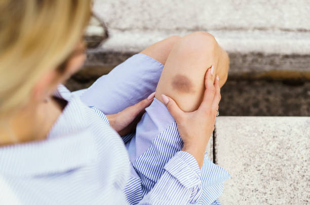 Bruised leg of a young woman, selective focus stock photo