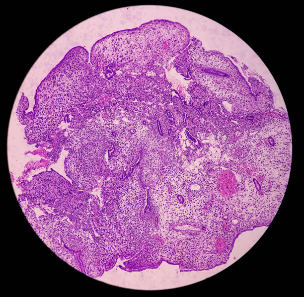 microfotografia do tecido endometrial, revela alteração decidual com necrose e hemorragia. endometriose. diagnóstico de câncer de endométrio ou útero. - endometrial adenocarcinoma - fotografias e filmes do acervo