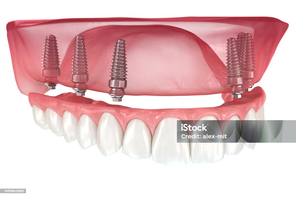 Maxillary Prosthesis Maxillary Prosthesis With Gum All On 6 System Supported By Implants ...