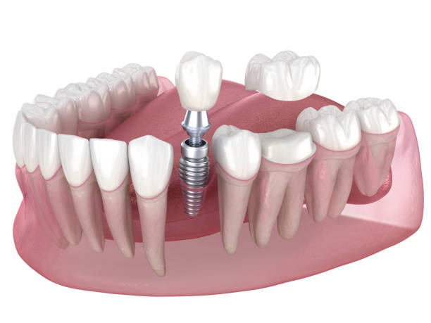 istock Dental implant and ceramic crown. Medically accurate tooth 3D illustration. 1495843102
