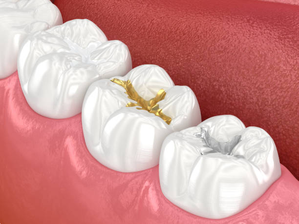 istock Dental fillings: ceramic, golden, metal. Dental 3D illustration 1495843113