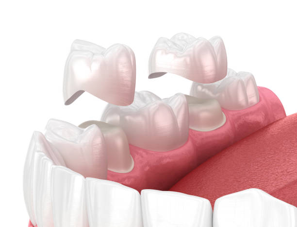 la colocación de coronas de porcelana sobre dientes premolares y molares. . ilustración 3d médicamente precisa - corona-dental fotografías e imágenes de stock