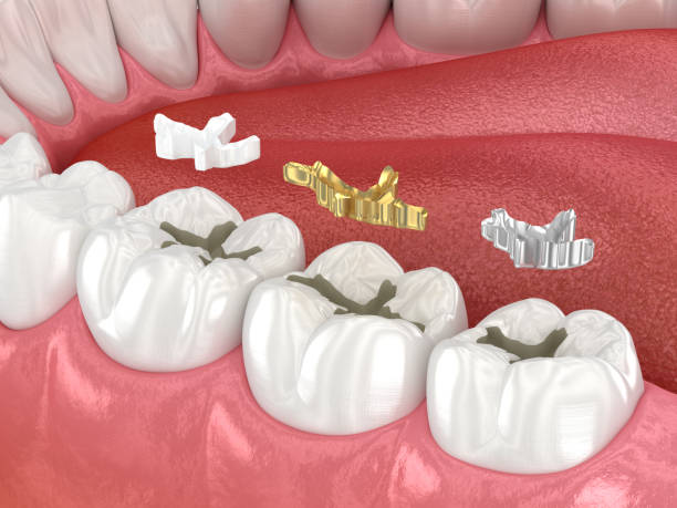 istock Dental fillings: ceramic, golden, metal. Dental 3D illustration 1495843143