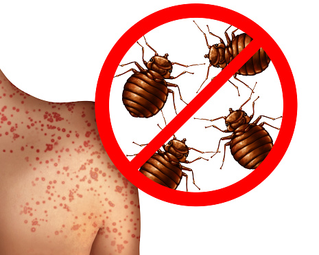 Bedbug bites on human skin  or bedbug infestation concept as a magnification close up of  parasitic insect pests as a hygiene symbol and health danger of bloodsucking parasites with 3D illustration style.