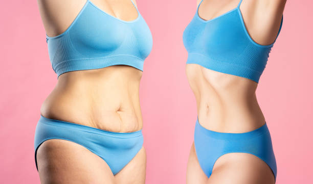 corps de la femme avant et après perte de poids sur fond rose, chirurgie plastique et concept de liposuccion - overweight women abdomen pot belly photos et images de collection