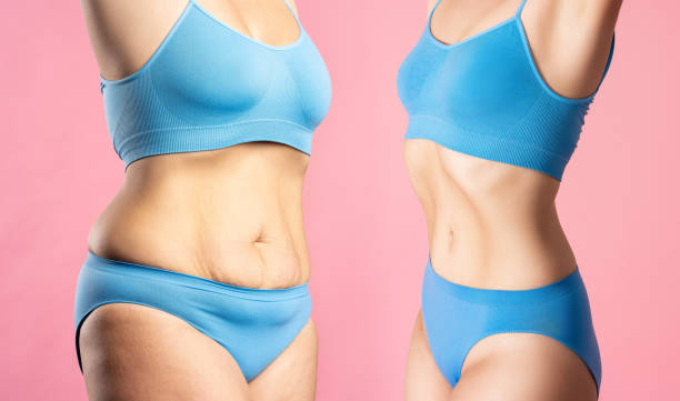женское тело до и после похудения на розовом фоне, концепция пластической хирургии и липосакции - overweight tummy tuck abdomen body стоковые фото и изображения