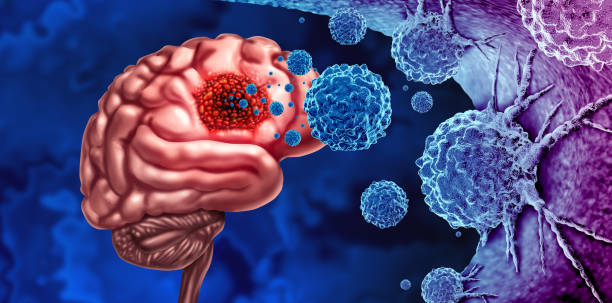 istock Glioma Cancer Tumor 1496150538