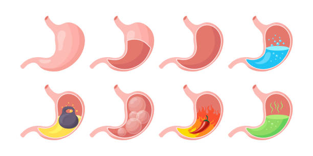 illustrations, cliparts, dessins animés et icônes de estomac humain sain et malsain, vide et plein, ensemble d’icônes.  anatomie du système digestif. - estomac