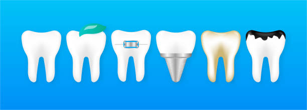 White and decayed teeth, dental implant. Different tooth conditions. Dental model of teeth in the gum. Dental care concept. Vector Illustration. White and decayed teeth, dental implant. Different tooth conditions. Dental model of teeth in the gum. Dental care concept. Vector Illustration cute cartoon dental implants stock illustrations