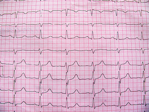 ECG background.