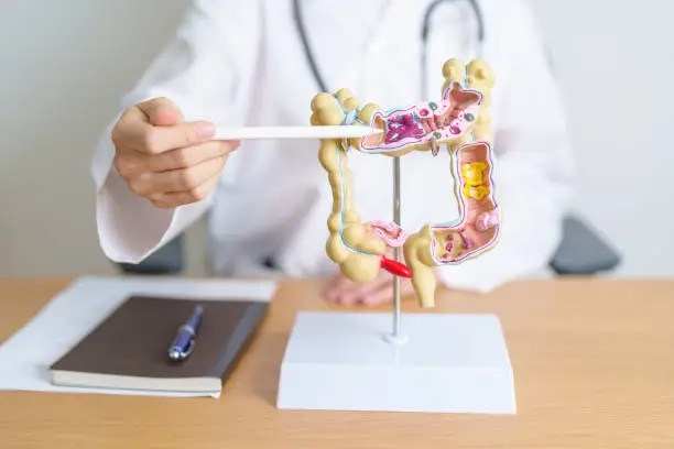 Photo of Doctor with human Colon anatomy model. Colonic disease, Large Intestine, Colorectal cancer, Ulcerative colitis, Diverticulitis, Irritable bowel syndrome, Digestive system and Health concept