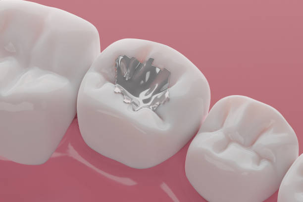 Teeth Silver amalgam filling Teeth coating with Silver amalgam filling technic, Decay teeth treatment concept. 3D rendering. alloy stock pictures, royalty-free photos & images